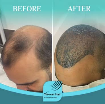 Slider image (6) United Hair Clinic